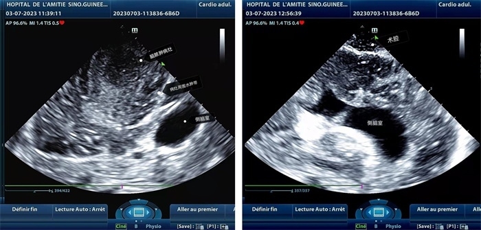 左圖顯示術中超聲見囊實性病變，大小約為4x4x3cm，病灶周圍腦組織水腫明顯；右圖為病灶切除后，術中超聲示術腔無病變殘留