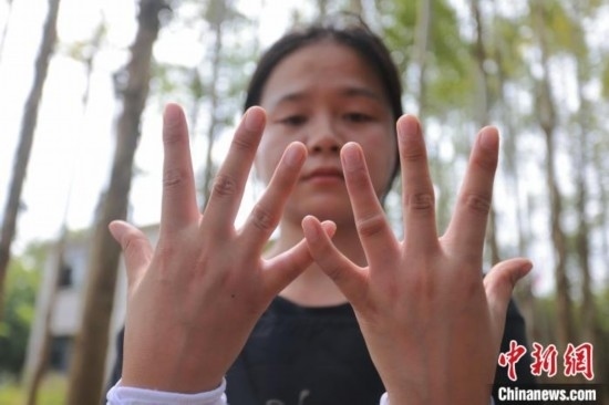 吳素英展示被蜜蜂蜇過的雙手。湯曉逵 攝